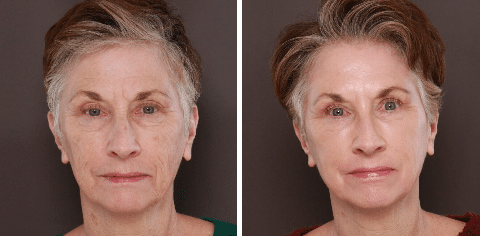 Utah Facial Plastics lower blepharoplasty eyelid lift